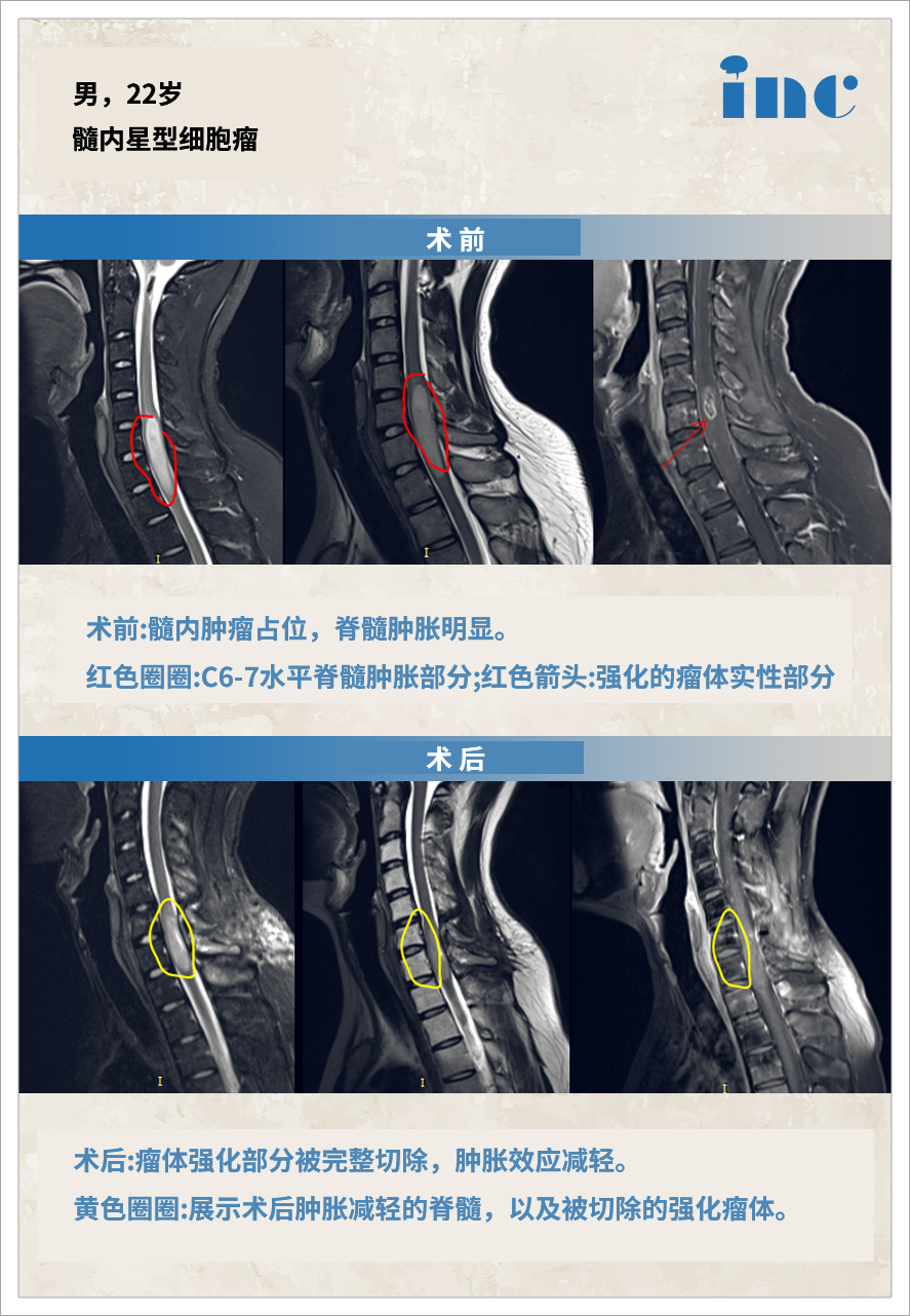 胶质瘤案例