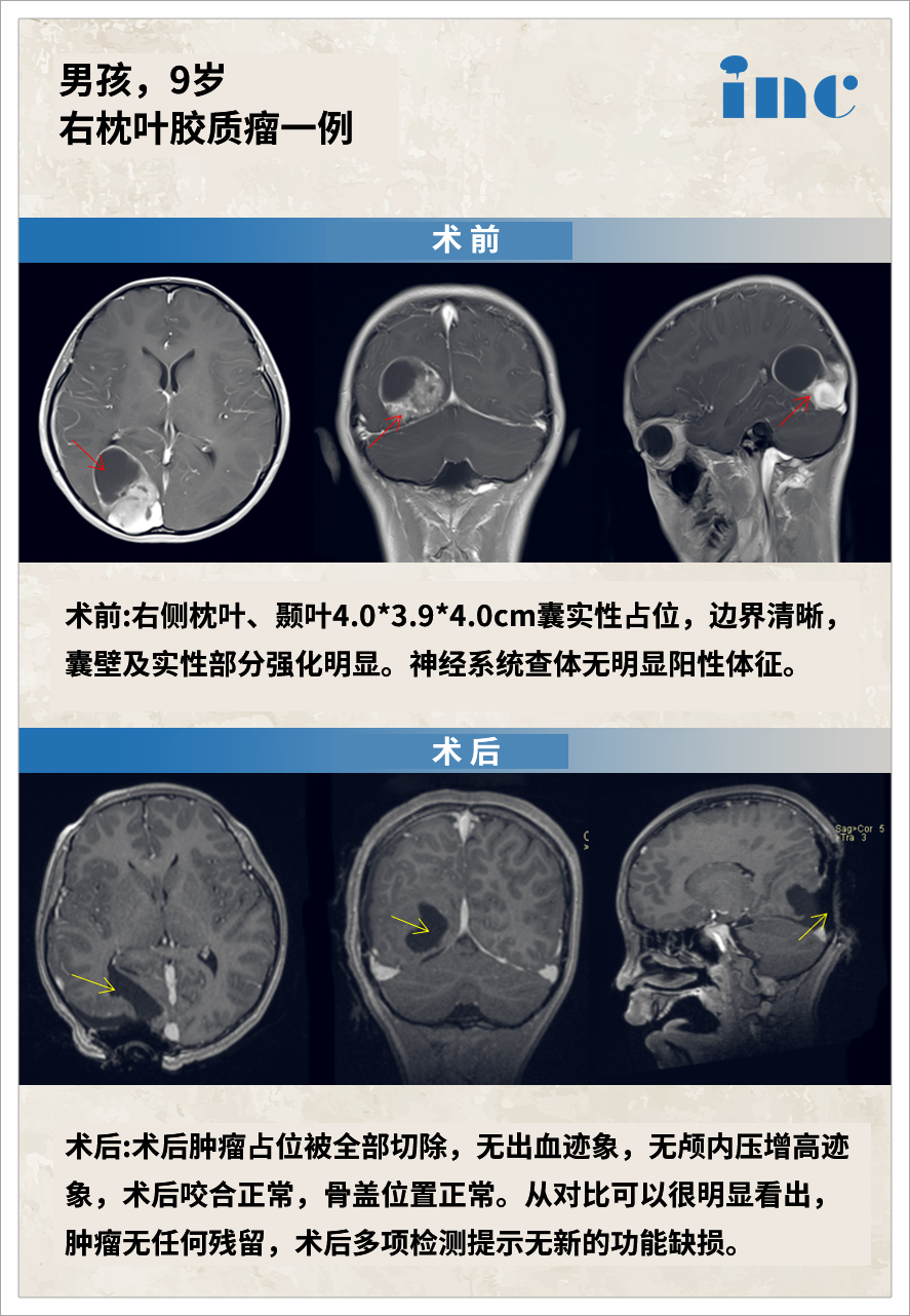 胶质瘤案例