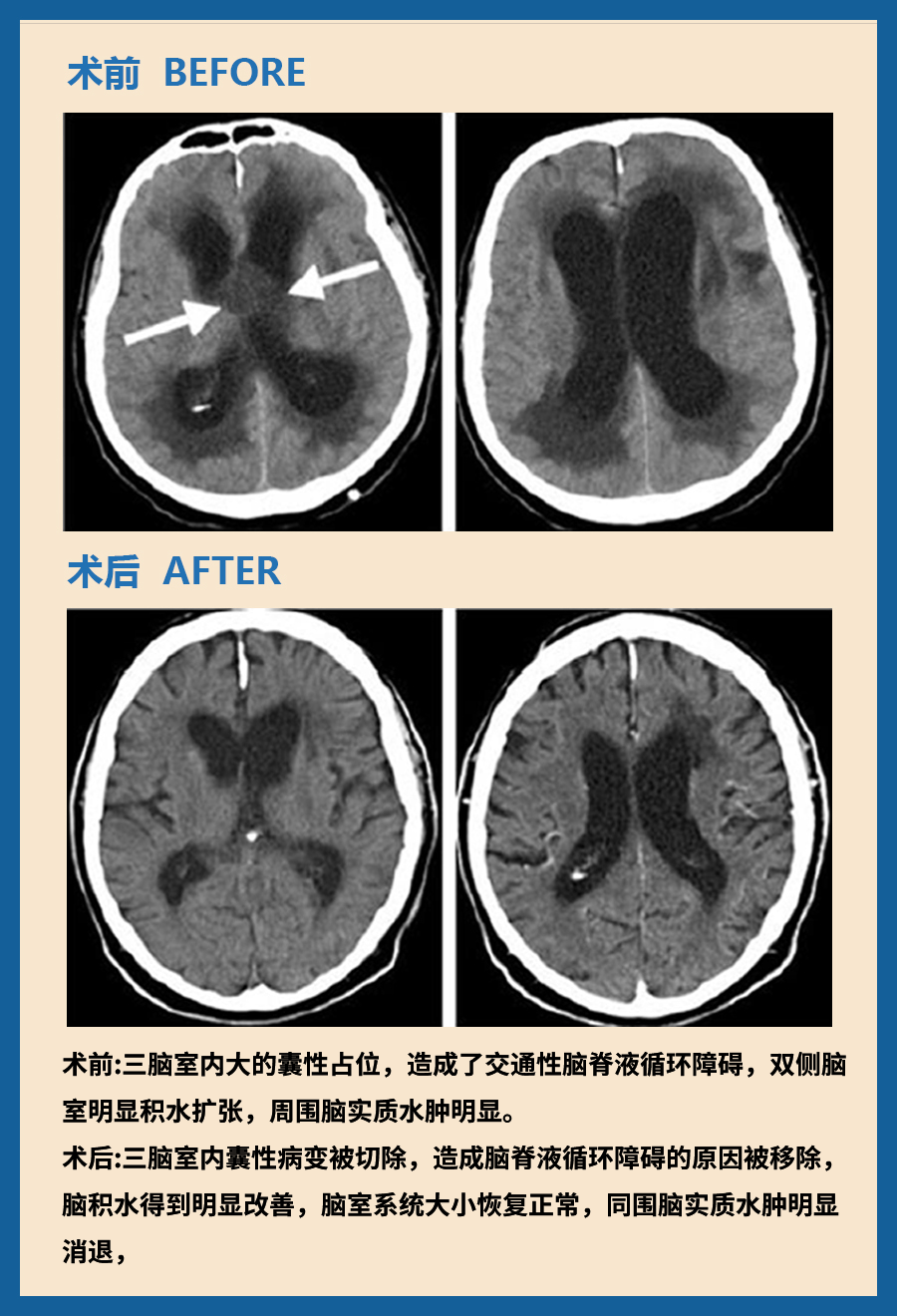 颅咽管瘤