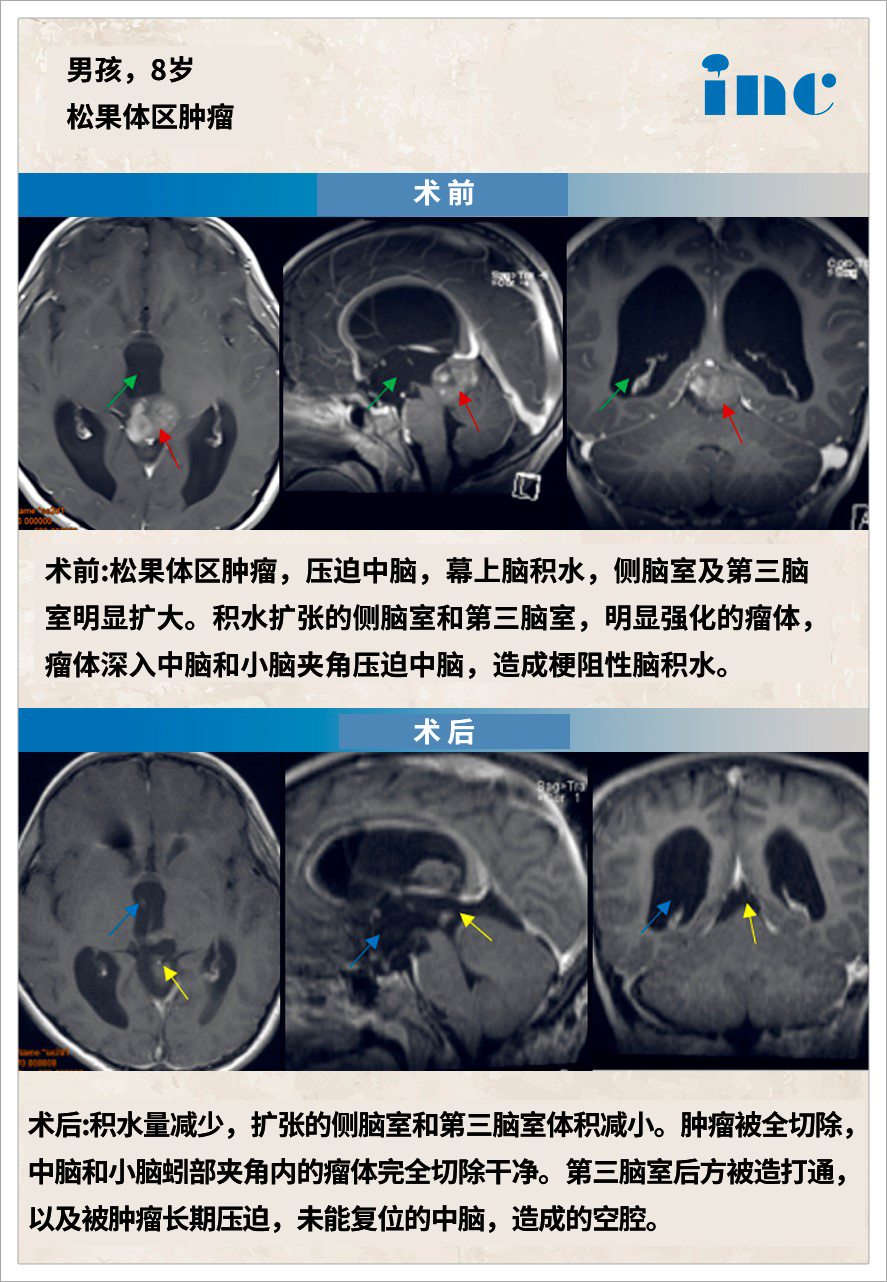 松果体区肿瘤案例