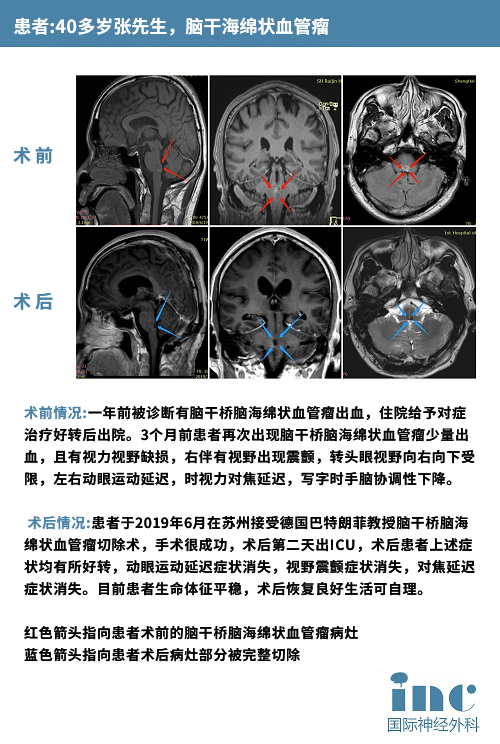 脑海绵状血管瘤案例