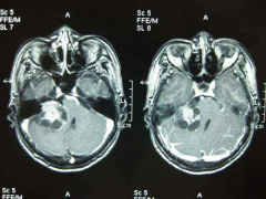双侧听神经瘤可以一次手术吗？