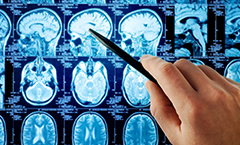 脑瘤质子疗法有什么副作用？