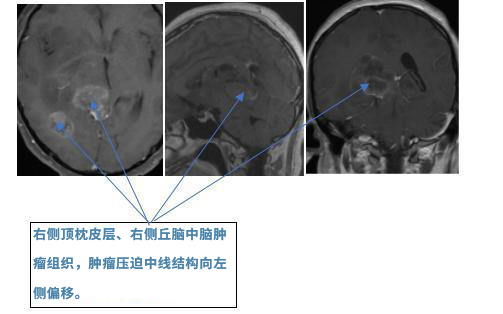 巴特朗菲教授手术过程