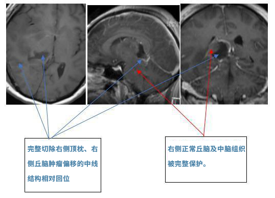 胶质母细胞瘤案例