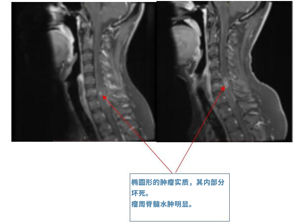 脊髓肿瘤