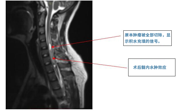 脊髓髓内肿瘤