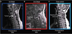 颈椎胶质瘤怎么治疗？ioMRI辅助下的颈部髓内弥漫性胶质瘤切除术1例