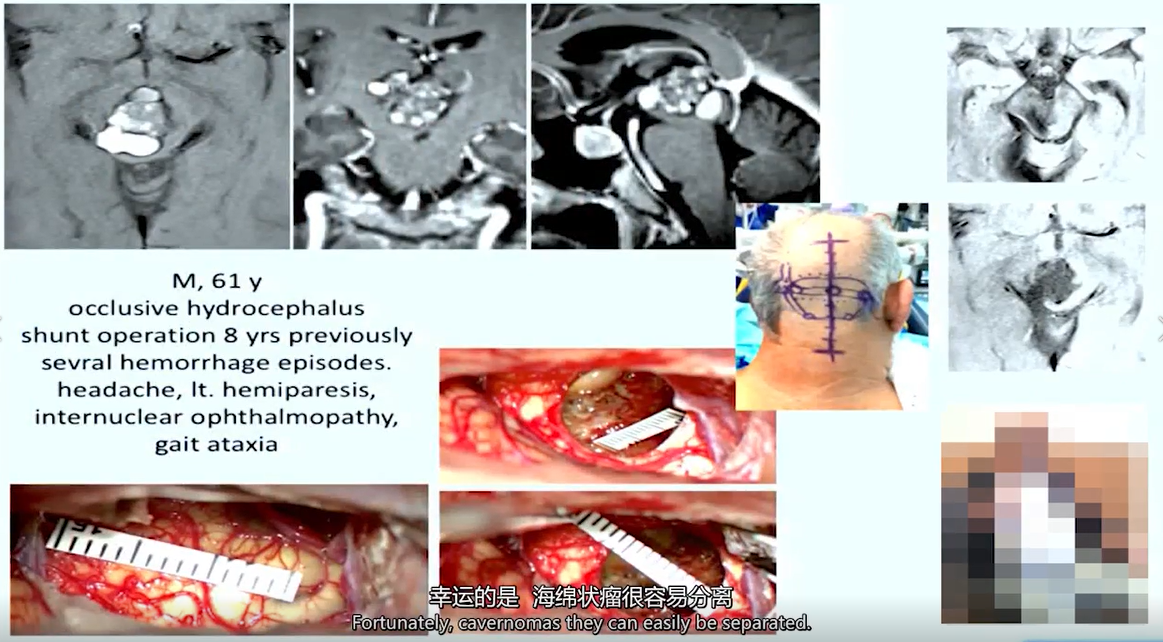 脑干海绵状血管瘤
