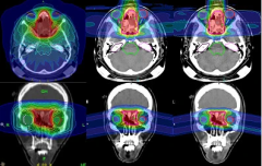 放疗提高颅内非典型脑膜瘤的无进展生存率