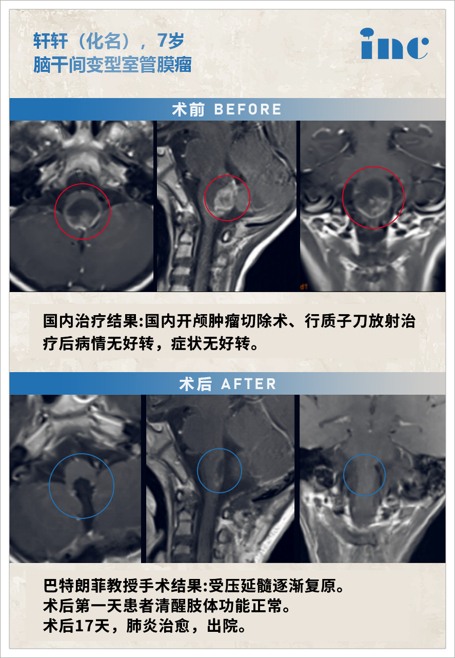 脑干肿瘤案例