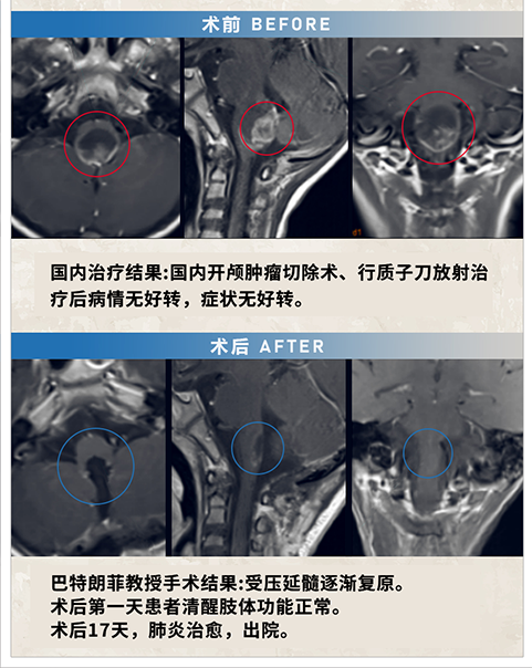 室管膜瘤案例