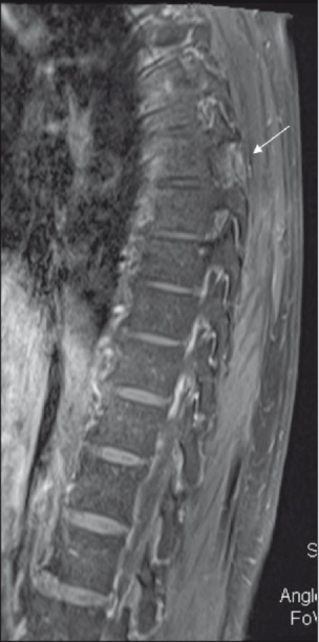 脊髓背侧硬膜外海绵状血管瘤案例