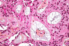 研究新发现：室管膜瘤为何预后不佳，容易复发？