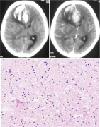 最初表现为脑出血的弥漫性星形细胞瘤1例