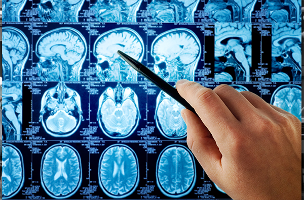 大脑神经胶质瘤能治好吗？