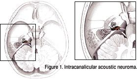 血管内听神经瘤