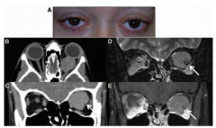 小儿视神经脑膜瘤:诊断和治疗的挑战