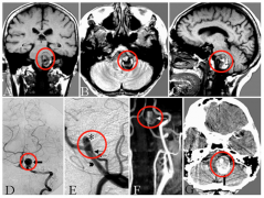 INC国际教授高度疑难脑动脉瘤成