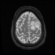 <b>大脑功能区脑瘤手术风险大吗？</b>
