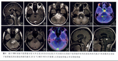 哪些脑干胶质瘤适合手术？世界