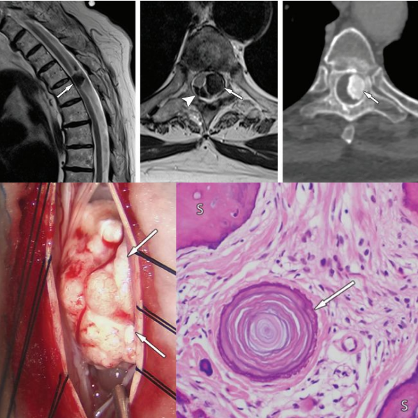 脊柱肿瘤常见有哪些病变，影像特点及手术分析
