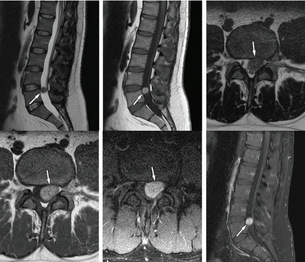 脊柱肿瘤常见有哪些病变，影像特点及手术分析