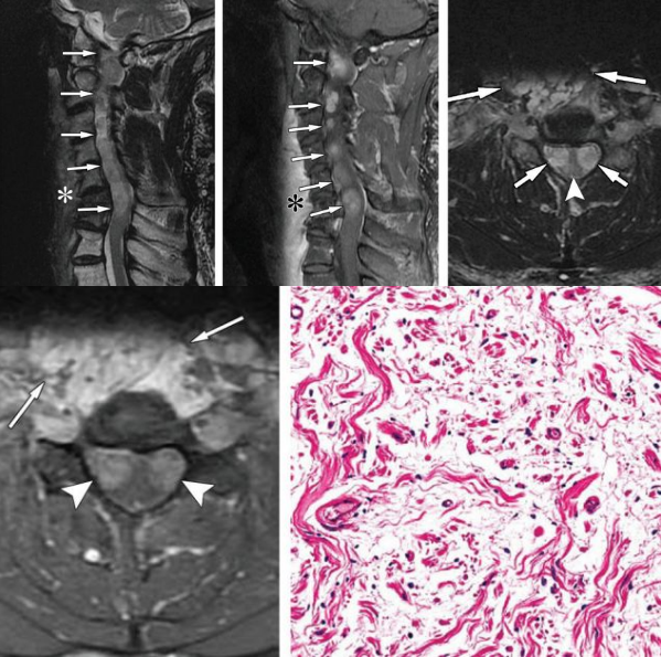 脊柱肿瘤常见有哪些病变，影像特点及手术分析