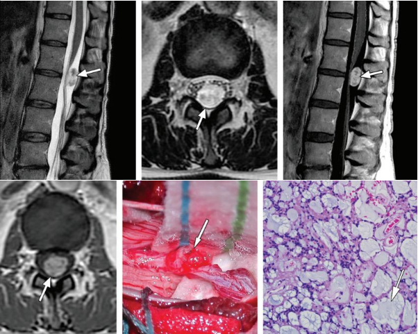 脊柱肿瘤常见有哪些病变，影像特点及手术分析