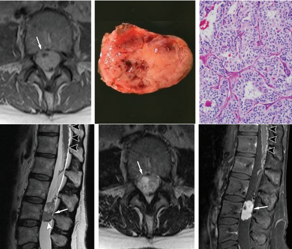 脊柱肿瘤常见有哪些病变，影像特点及手术分析