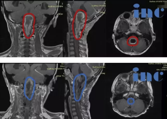 6岁女孩脑干延髓巨大胶质瘤获95%以上切除