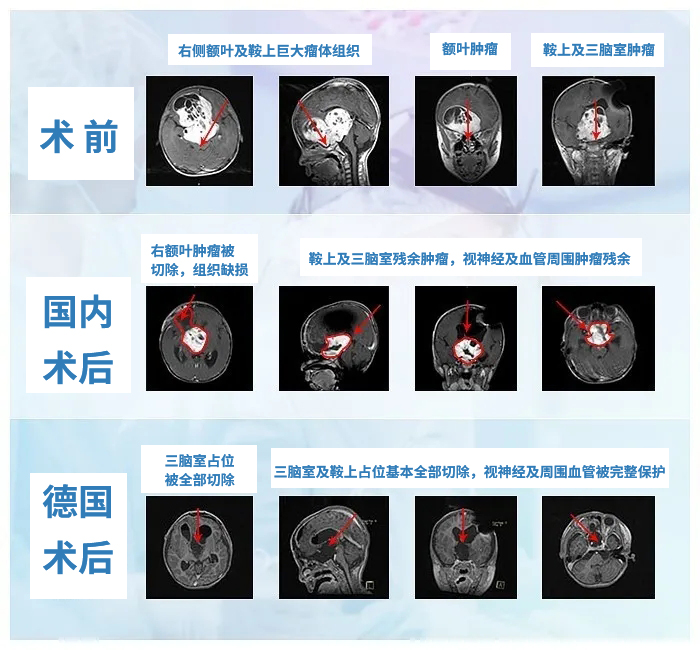 失明的5岁视神经胶质瘤患儿，