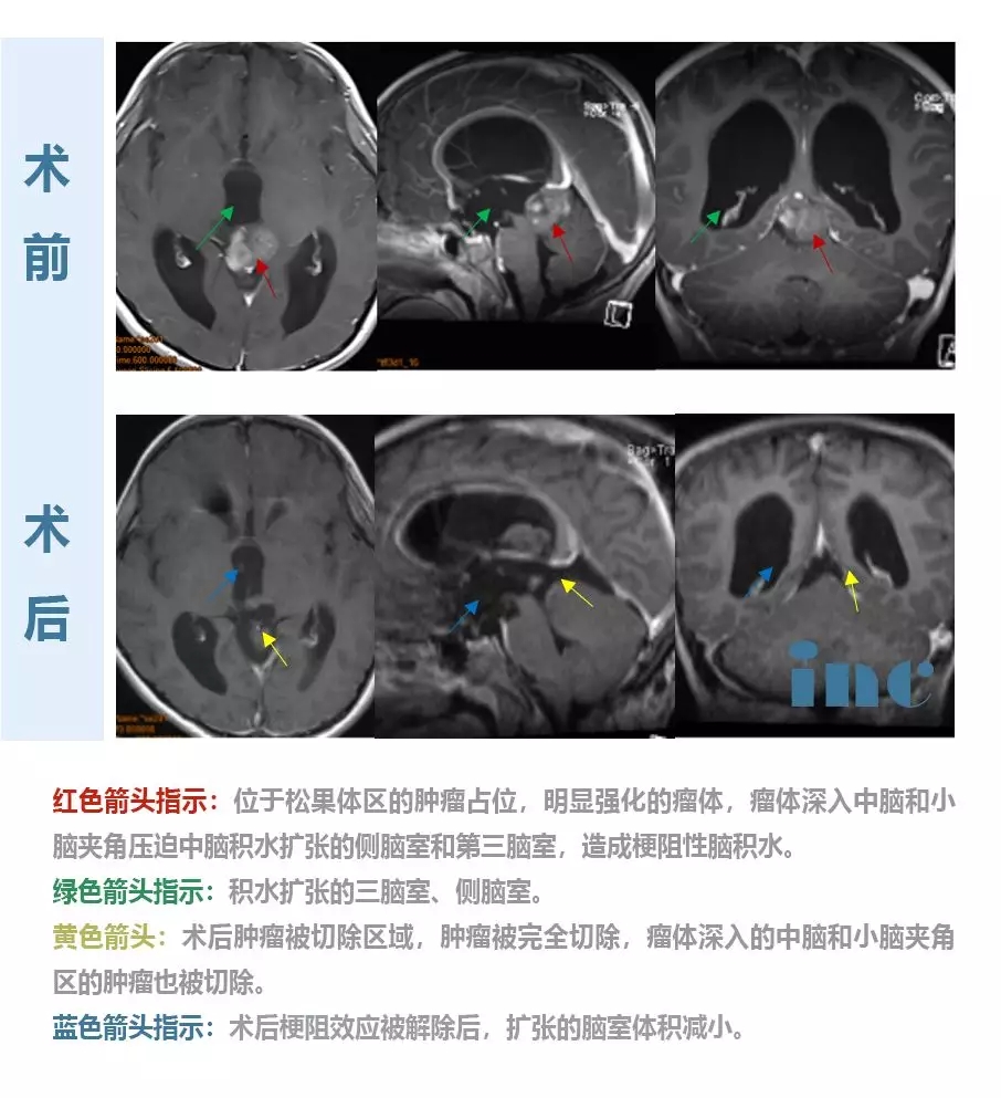 8岁松果体区肿瘤男孩