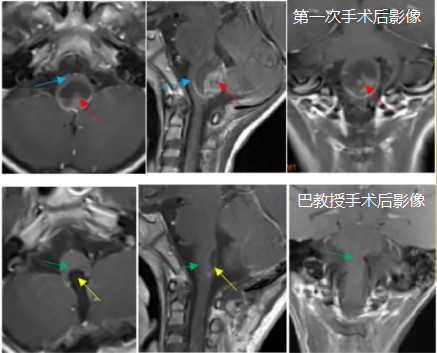 7岁脑干室管膜瘤患儿，手术全切后恢复良好