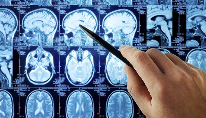 脑胶质瘤手术复发表现有哪些？