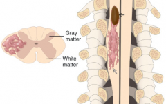 多图详解罕见的脊髓星形细胞瘤