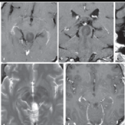 中脑顶盖脑瘤、累及第四脑室，全切后11年无复发