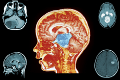 脑瘤的早期症状有哪些？脑瘤能治吗？