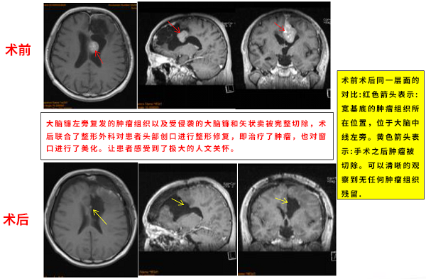 矢状窦旁脑膜瘤案例