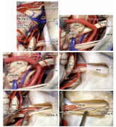 “显微神经外科解剖学（MNA）”的演变