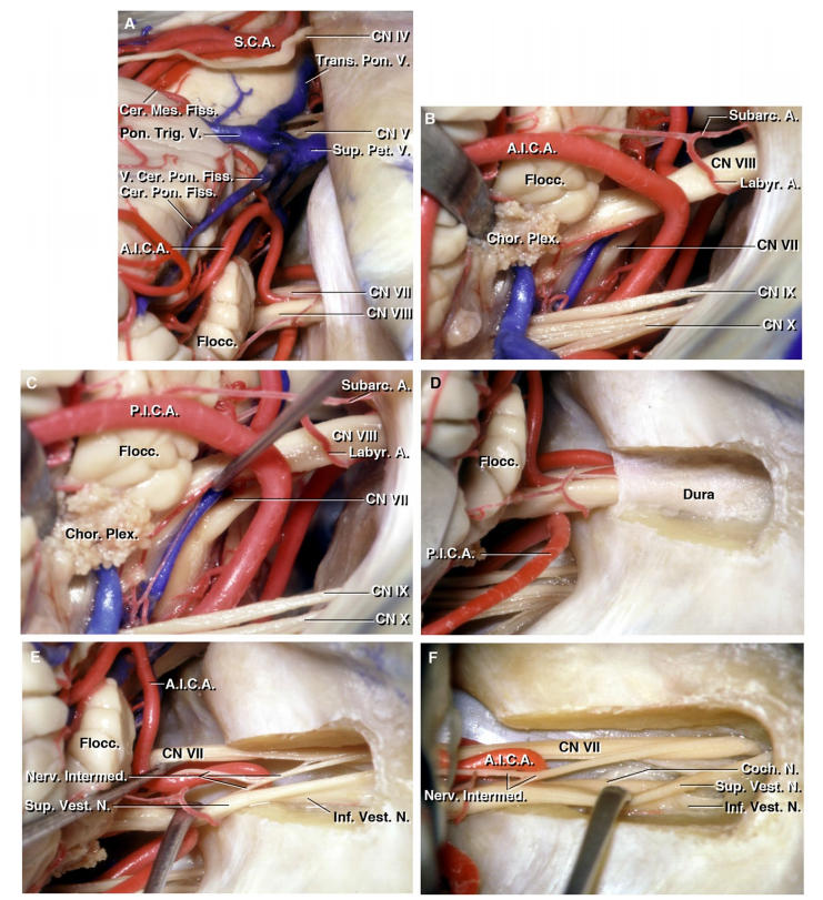 右桥小脑角的显微外科地形解剖