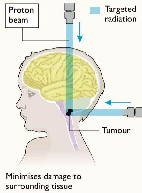 质子治疗脑肿瘤
