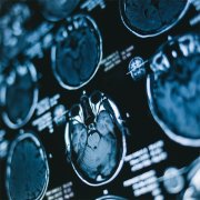 脑瘤能治好吗？