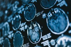 性别、年龄是恶性脑肿瘤患者护理和生存的关键因素