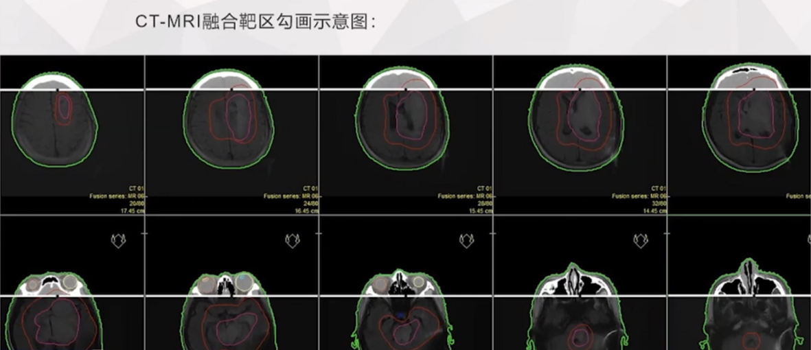 巨大丘脑胶质瘤治疗