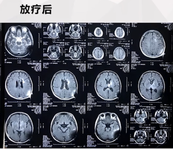 巨大丘脑胶质瘤治疗