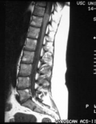 脊柱脑膜瘤影像学检查