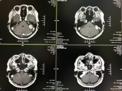 小脑幕脑膜瘤分类及常见的手术入路