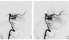 如何确诊AVM？脑动静脉畸形检查