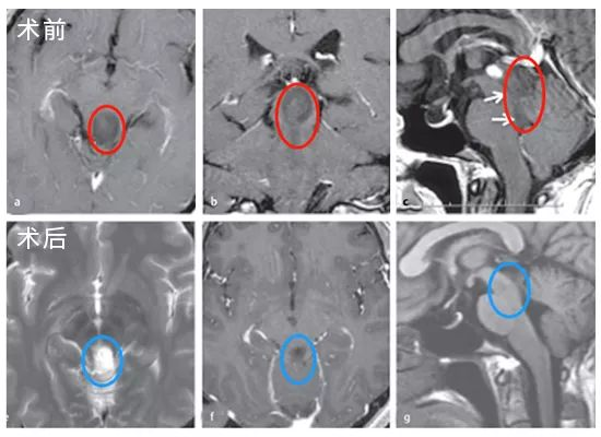 脑瘤治疗后